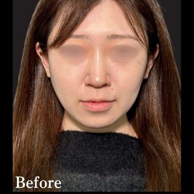PRISM小顔美肌リフト　8本の症例写真[ビフォー]