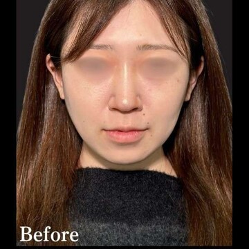 PRISM Beauty Clinicのリフトアップの症例写真[ビフォー]