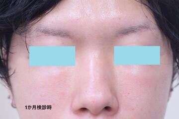 医療法人秀晄会 心斎橋コムロ美容外科クリニックのしわ・たるみ整形(注入、糸、フェイスリフト)の症例写真[ビフォー]