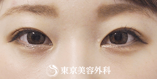 埋没二重 まぶたの脂肪取り 自然な二重で美人顔に 二重埋没法 その他 二重整形 の症例 東京美容外科 Cs 美容医療の口コミ広場