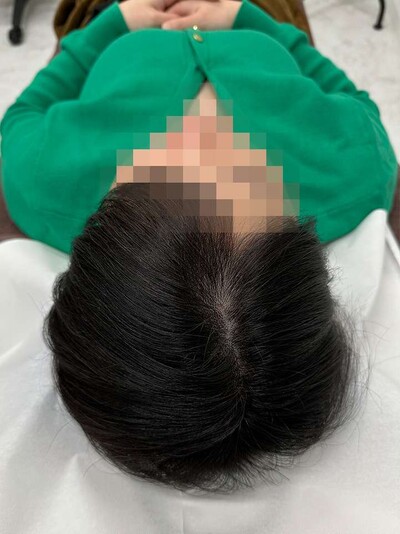 ヘアアートメイク｜40代｜2回の症例写真[アフター]