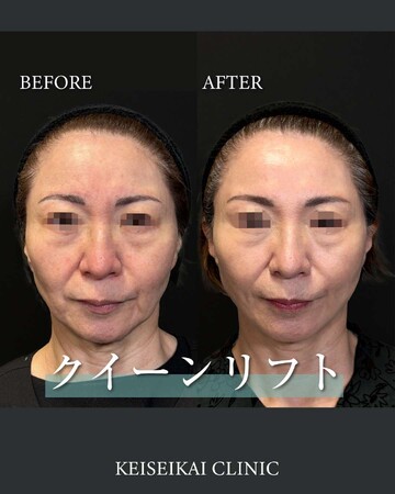恵聖会クリニックのしわ・たるみ整形(注入、糸、フェイスリフト)の症例写真