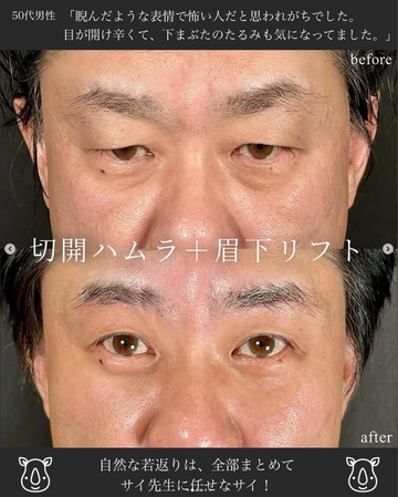 SAI CLINIC （サイクリニック）の目元・クマ・眉下・涙袋整形の症例写真
