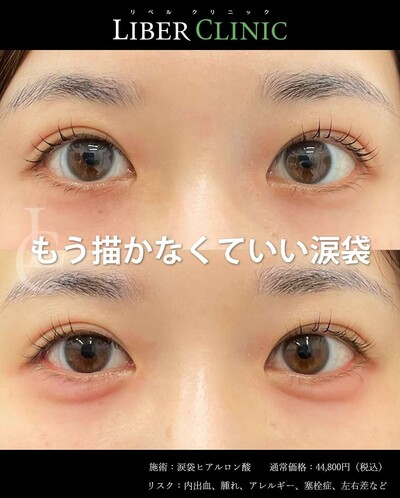 涙袋のヒアルロン酸注射の症例写真