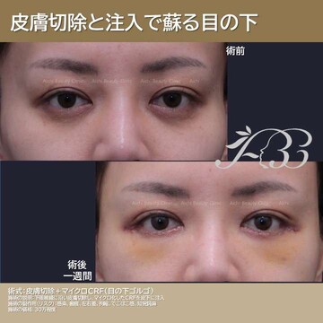 あいちビューティークリニック栄本院の目元・クマ・眉下・涙袋整形の症例写真
