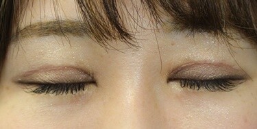 二重切開後の修正手術 術後1ヶ月 二重切開法 その他 二重整形 の症例写真 画像 カリスクリニック Cs 美容医療の口コミ広場