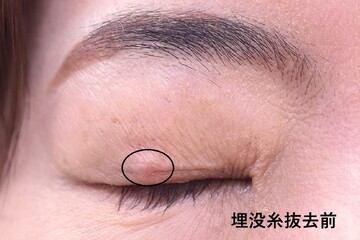 医療法人秀晄会 心斎橋コムロ美容外科クリニックの目・二重整形の症例写真[ビフォー]