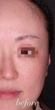 ピコレーザーを用いた美肌治療 シミ取り 肝斑 毛穴治療の症例写真 画像 Select Clinic セレクトクリニック 大阪茶屋町院 Cs 美容医療の口コミ広場