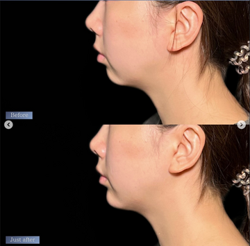 PRISM Beauty Clinicのしわ・たるみ整形(注入、糸、フェイスリフト)の症例写真