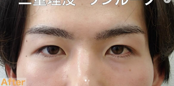 さかえ皮フ科クリニック（旧：ニドークリニック名古屋）の症例写真[アフター]
