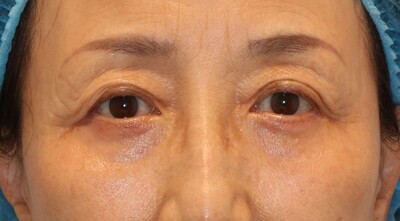 ハムラ法の症例写真[アフター]