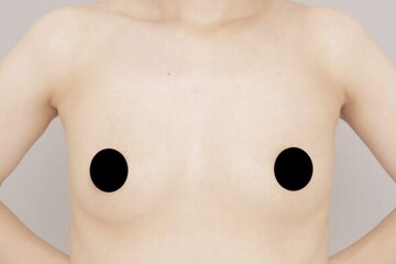 Mods Clinic (モッズクリニック)の豊胸・胸の整形の症例写真[ビフォー]