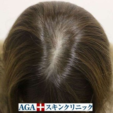 AGAスキンクリニックの薄毛治療の症例写真[ビフォー]