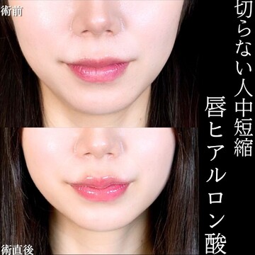 アリエル美容クリニック 大宮院の口元・唇の整形・人中短縮の症例写真