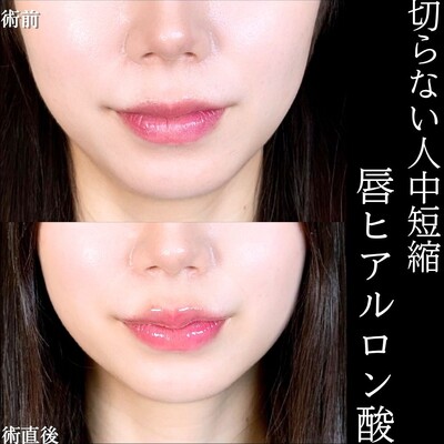 唇ヒアルロン酸の症例写真