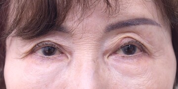 医療法人秀晄会 心斎橋コムロ美容外科クリニックの目・二重整形の症例写真