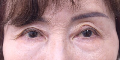 60代　女性　左中切開＋挙筋短縮　くぼみ目＋眼瞼下垂の症例写真