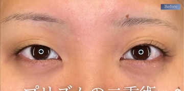 PRISM Beauty Clinicの目・二重整形の症例写真[ビフォー]