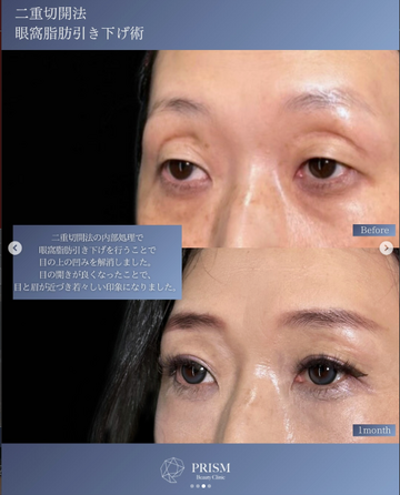 PRISM Beauty Clinicの目・二重整形の症例写真