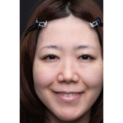 裏ハムラ法で埋もれた涙袋と目元の影を改善の症例写真[ビフォー]