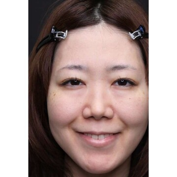 聖心美容クリニックの目元の症例写真[ビフォー]