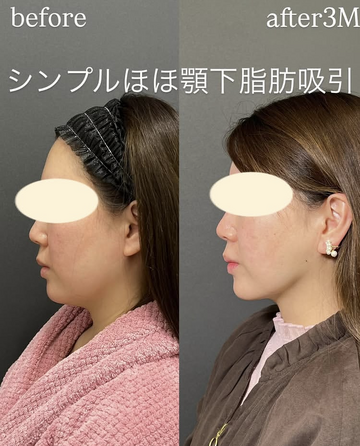 Plume Clinicの脂肪吸引の症例写真