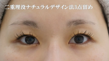 静岡美容外科橋本クリニックの二重の症例写真[ビフォー]