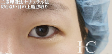 静岡美容外科橋本クリニックの二重の症例写真[ビフォー]