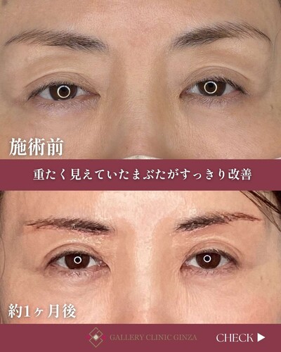 上瞼のたるみ改善 眉下切開の症例写真