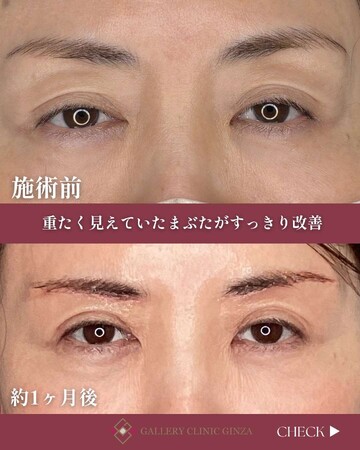 ギャラリークリニックの目元・クマ・眉下・涙袋整形の症例写真