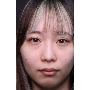 聖心美容クリニックの目元の症例写真[ビフォー]