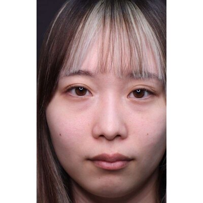 裏ハムラ法で目元のふくらみと影を改善（術後3ヶ月）の症例写真[ビフォー]