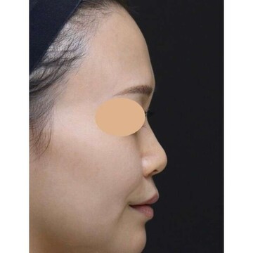 聖心美容クリニックの鼻の症例写真[ビフォー]