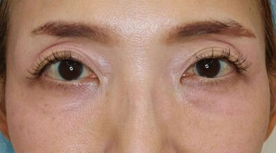 下瞼脱脂の症例写真[アフター]
