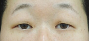 タウン形成外科クリニックの目・二重整形の症例写真[ビフォー]