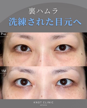 KNOT CLINIC AOYAMAの目元・クマ・眉下・涙袋整形の症例写真