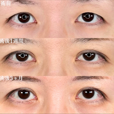 アリエルクイックループトリプル/瞼の上の脂肪取りの症例写真