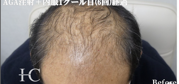 静岡美容外科橋本クリニックの薄毛治療の症例写真[ビフォー]