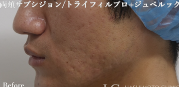 静岡美容外科橋本クリニックのニキビ・ニキビ跡の治療の症例写真[ビフォー]