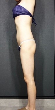 背中痩せ ダイエットの症例写真 画像 美容医療の口コミ広場