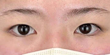 AI Beauty Clinicの二重の症例写真[ビフォー]