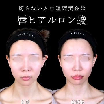 アリエル美容クリニック 大宮院の口元・唇の整形・人中短縮の症例写真