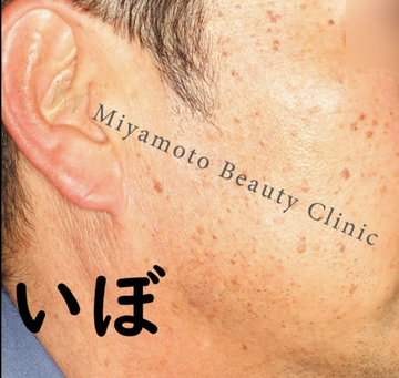 みやもと美容クリニックのほくろ除去・あざ治療・イボ治療の症例写真[ビフォー]