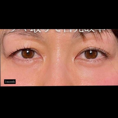 クマ取りで目元改革しませんか？💡の症例写真[アフター]