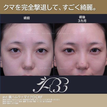 あいちビューティークリニック栄本院の目元・クマ・眉下・涙袋整形の症例写真