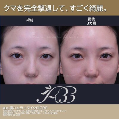 どんな表情でも魅せる裏ハムラ  の症例写真