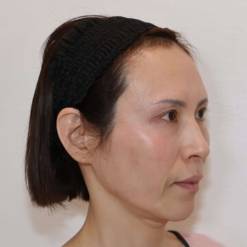 すなおクリニックのしわ・たるみ整形(注入、糸、フェイスリフト)の症例写真[ビフォー]