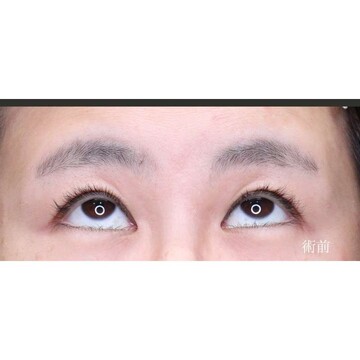 聖心美容クリニックの二重の症例写真[ビフォー]