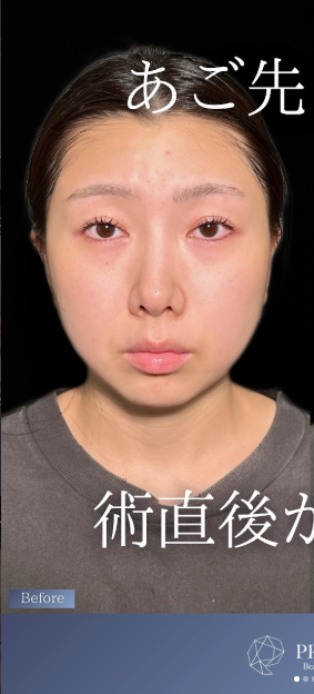 PRISM Beauty Clinicのしわ・たるみ整形(注入、糸、フェイスリフト)の症例写真[ビフォー]