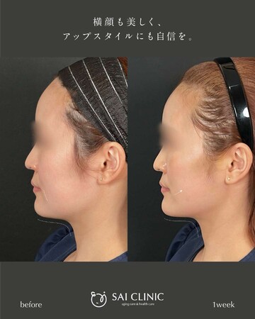 SAI CLINIC （サイクリニック）のリフトアップの症例写真
